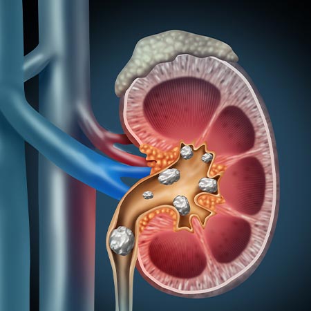 Kidney Stone Treatment in Vijayawada